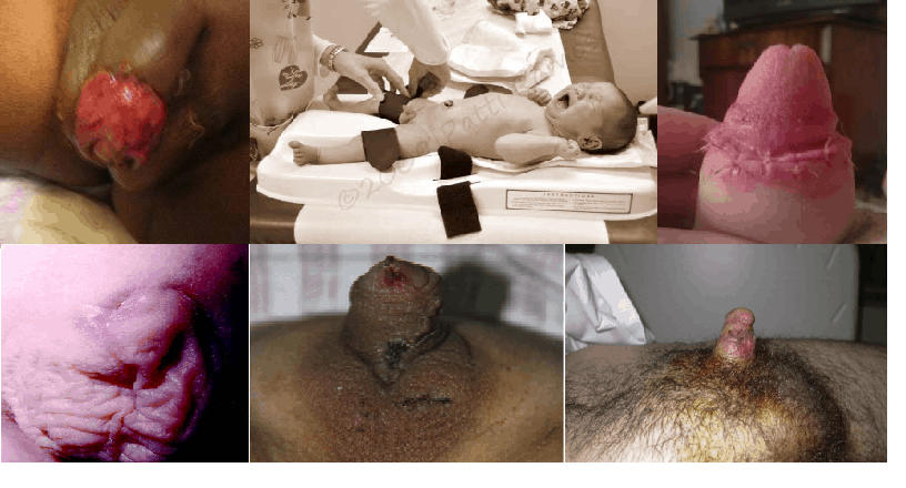 circumcision six reasons not to